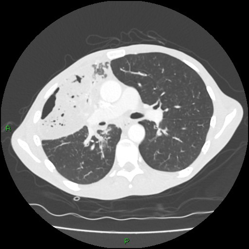 Acute right lung abscess (Radiopaedia 34806-36258 Axial lung window 84).jpg