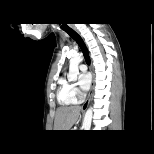 File:Acute segmental pulmonary emboli and pulmonary infarction (Radiopaedia 62264-70444 Sagittal C+ CTPA 36).jpg