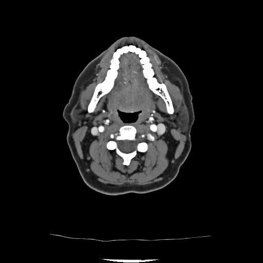 Acute subarachnoid hemorrhage and accessory anterior cerebral artery (Radiopaedia 69231-79009 Axial C+ arterial phase 60).jpg