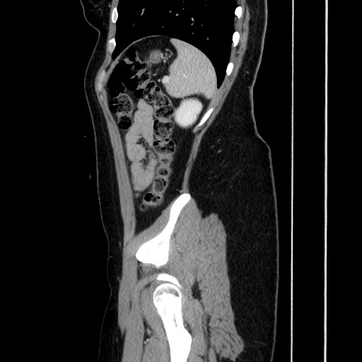 File:Acute uncomplicated appendicitis (Radiopaedia 73704-84499 Sagittal C+ portal venous phase 158).jpg