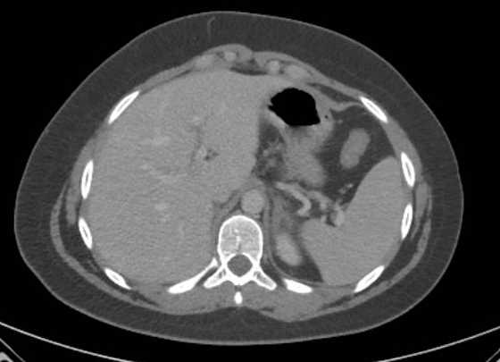 File:Acute unilateral nonhemorrhagic adrenal infarction (Radiopaedia 67560-76957 Axial renal parenchymal phase 15).jpg
