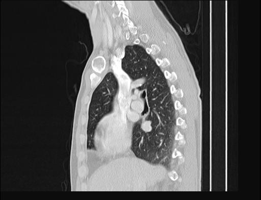 File:Addison disease (Radiopaedia 49318-54412 Sagittal lung window 39).jpg