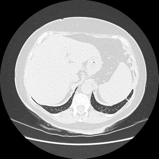 Adenocarcinoma in situ of lung (Radiopaedia 38685-40829 B 224).png