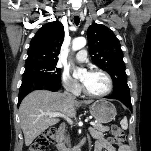 Adenocarcinoma of the lung (Radiopaedia 59871-67325 Coronal C+ arterial phase 29).jpg
