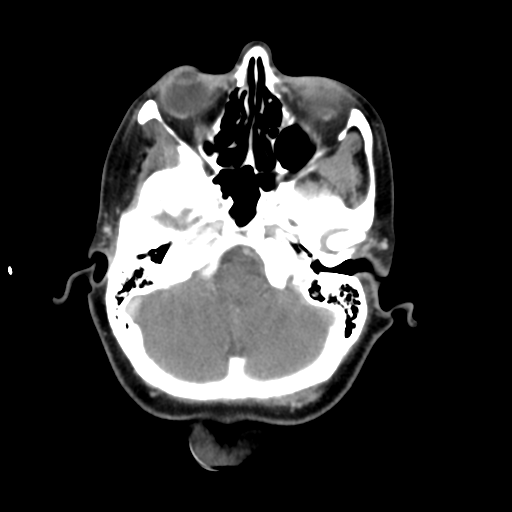File:Adenoid cystic tumor of palate (Radiopaedia 46980-51518 Axial C+ delayed 16).png