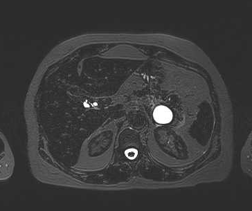 File:Adenomyomatosis of the gallbladder (Radiopaedia 50246-55587 Axial 70).png