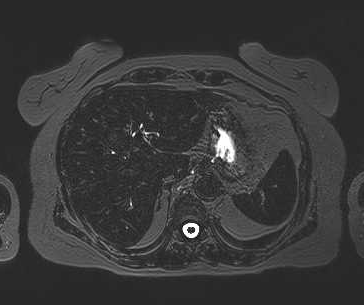 File:Adenomyomatosis of the gallbladder (Radiopaedia 50246-55587 Axial 96).png
