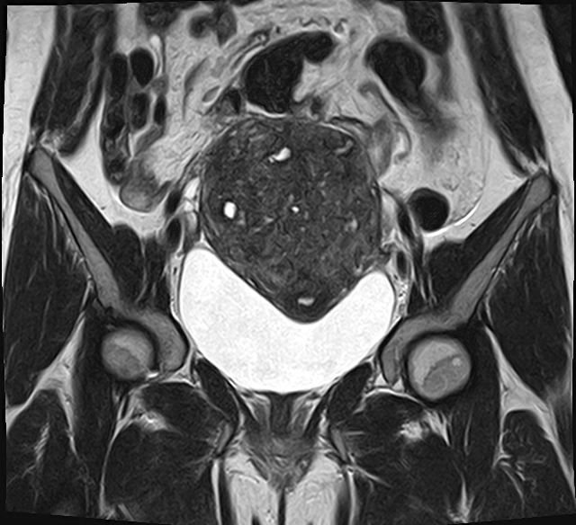 File:Adenomyosis - ovarian endometriomas (Radiopaedia 67031-76350 Coronal T2 11).jpg