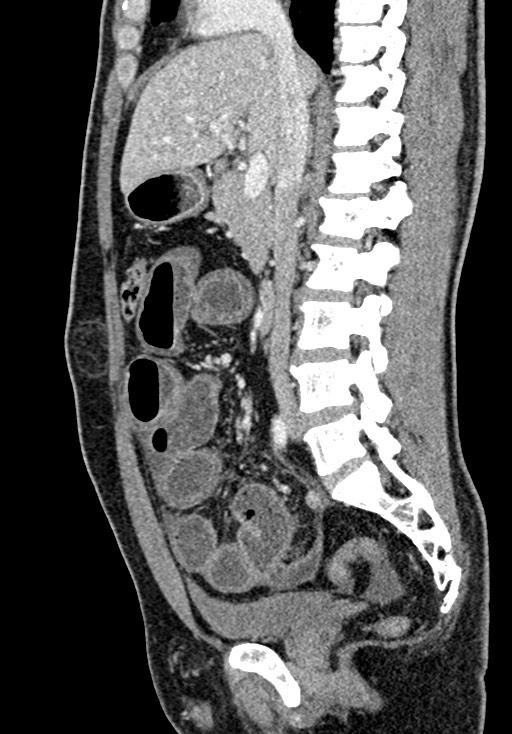 Adhesional small bowel obstruction (Radiopaedia 58900-66131 Sagittal C+ portal venous phase 112).jpg