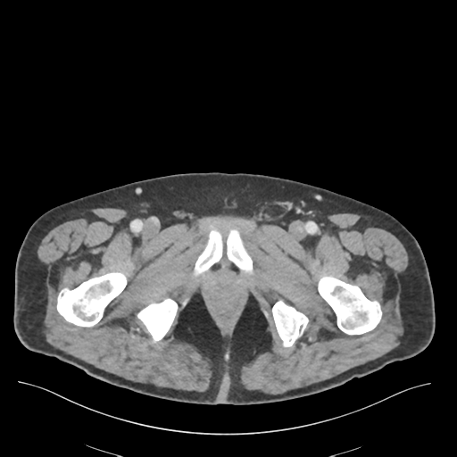 File:Adhesions within abdominal wall hernia (Radiopaedia 58283-65394 Axial C+ portal venous phase 87).png