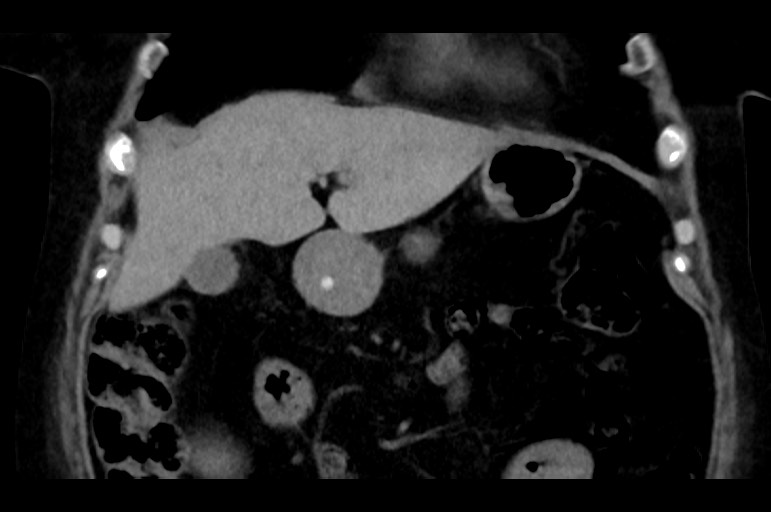 Adrenal cortical carcinoma (Radiopaedia 64017-72769 Coronal non-contrast 18).jpg
