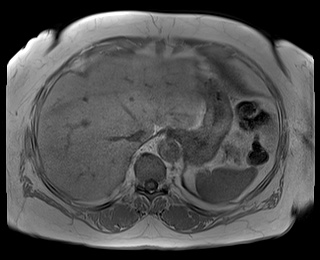 File:Adrenal cortical carcinoma (Radiopaedia 64017-72770 Axial T1 in-phase 10).jpg