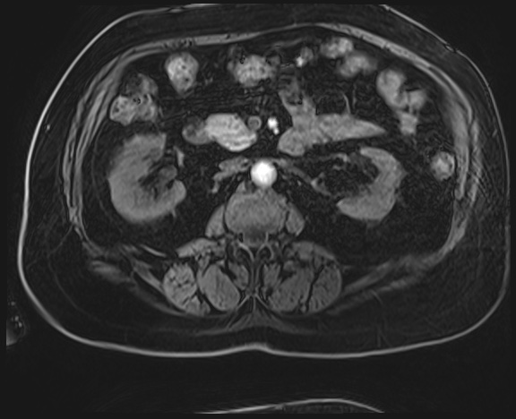 Adrenal cortical carcinoma (Radiopaedia 64017-72770 H 25).jpg