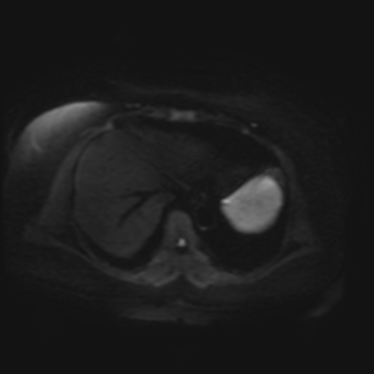 Adrenal cortical carcinoma (Radiopaedia 70906-81116 Axial DWI 3).jpg