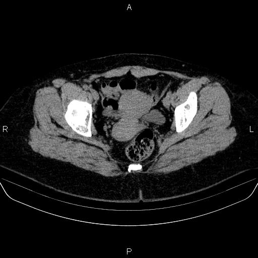 File:Adrenal cortical carcinoma (Radiopaedia 84882-100379 Axial non-contrast 87).jpg