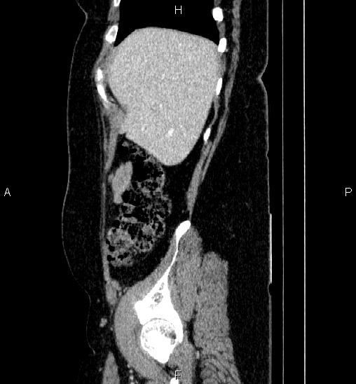 Adrenal cortical carcinoma (Radiopaedia 84882-100379 Sagittal C+ portal venous phase 14).jpg