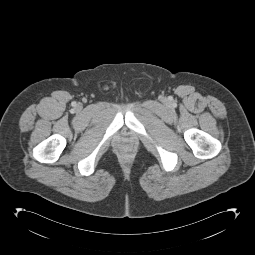 Adrenal cyst (Radiopaedia 45625-49776 Axial C+ portal venous phase 103).png