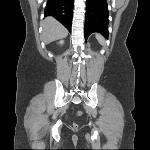 File:Adrenal cyst (Radiopaedia 45625-49776 Coronal C+ portal venous phase 56).png