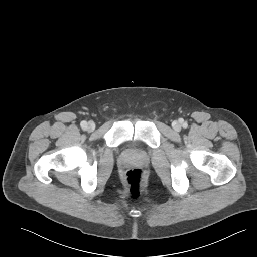 Adrenal cyst (Radiopaedia 45625-49777 Axial C+ portal venous phase 101).png