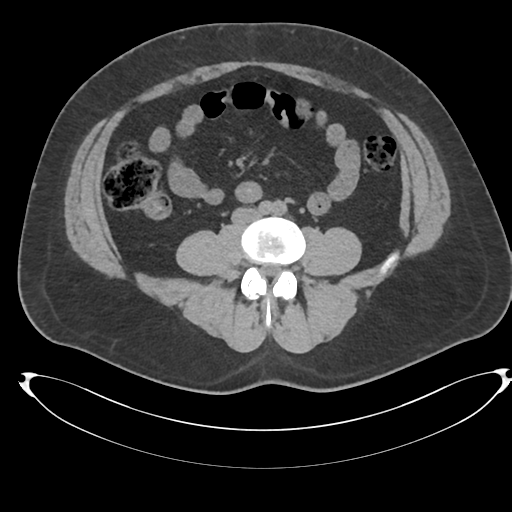 Adrenal cyst (Radiopaedia 45625-49778 Axial non-contrast 78).png