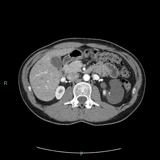 File:Adrenal cystic lymphangioma (Radiopaedia 83161-97534 Axial C+ arterial phase 36).jpg