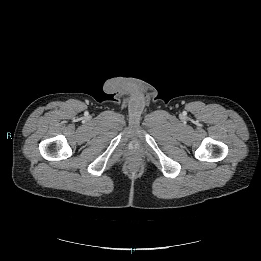 Adrenal cystic lymphangioma (Radiopaedia 83161-97534 Axial C+ portal venous phase 109).jpg