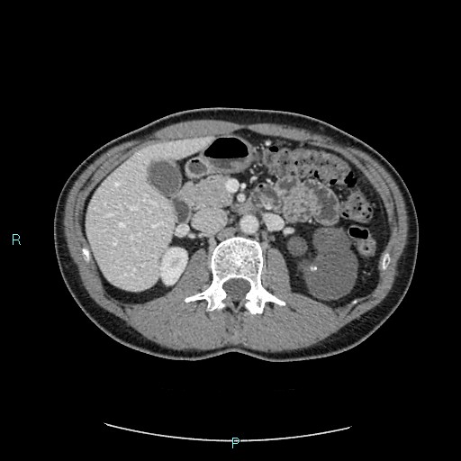 Adrenal cystic lymphangioma (Radiopaedia 83161-97534 Axial C+ portal venous phase 36).jpg