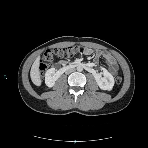 Adrenal cystic lymphangioma (Radiopaedia 83161-97534 Axial C+ portal venous phase 48).jpg