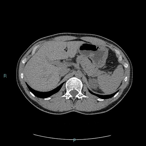 File:Adrenal cystic lymphangioma (Radiopaedia 83161-97534 Axial non-contrast 28).jpg