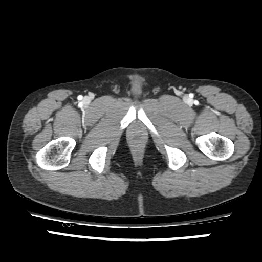 Adrenal gland trauma (Radiopaedia 81351-95078 Axial Dual bolus trauma C+ 125).jpg