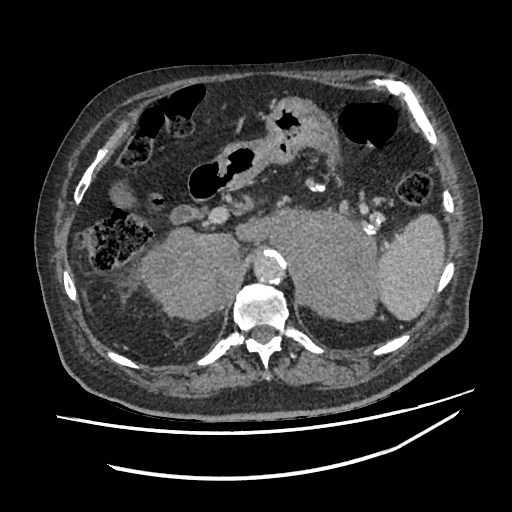 Adrenal lymphoma (Radiopaedia 84145-99415 Axial C+ portal venous phase 29).jpg