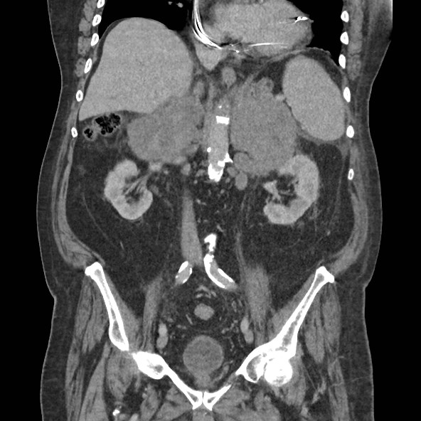 Adrenal lymphoma (Radiopaedia 84145-99415 Coronal C+ portal venous phase 47).jpg
