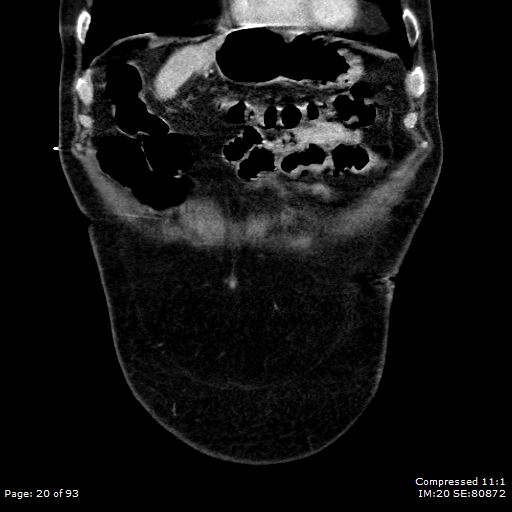 Adrenal metastasis (Radiopaedia 78425-91079 Sagittal C+ portal venous phase 7).jpg