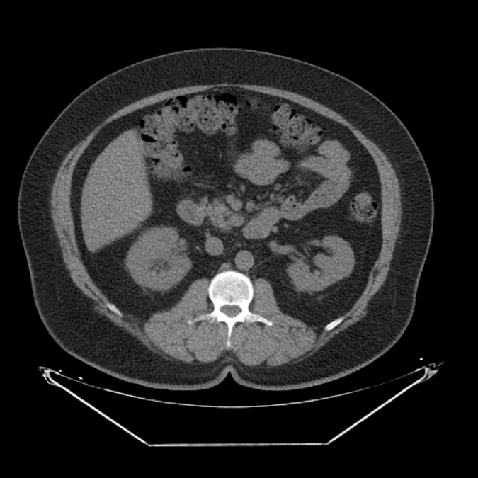 Adrenal myelolipoma (Radiopaedia 26278-26407 Axial non-contrast 28).jpg