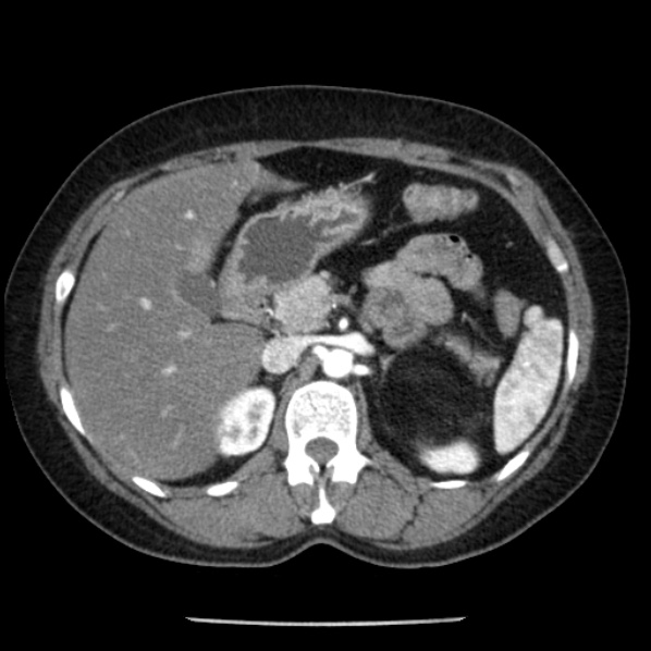 Adrenal myelolipoma (Radiopaedia 43401-46759 Axial C+ arterial phase 33).jpg