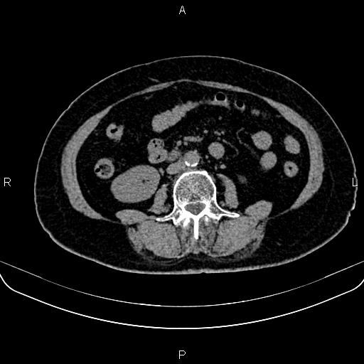 Adrenal myelolipoma (Radiopaedia 82742-96986 Axial non-contrast 87).jpg