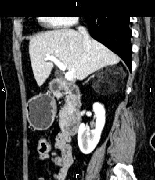 Adrenal myelolipoma (Radiopaedia 82742-96986 Sagittal renal cortical phase 44).jpg