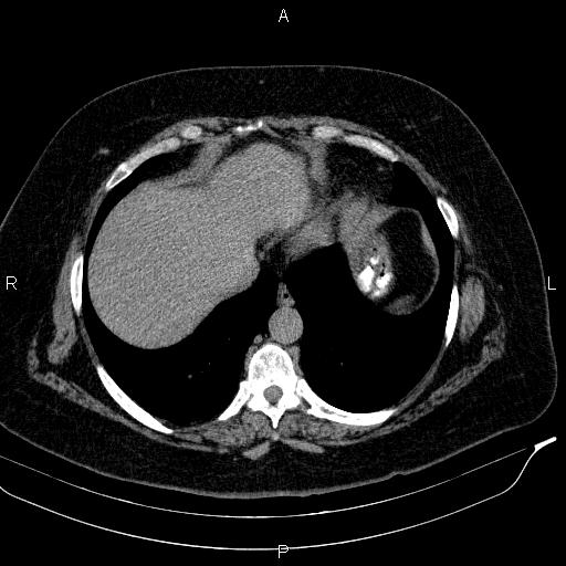 File:Adrenal myelolipoma (Radiopaedia 84319-99617 Axial With oral contrast 26).jpg