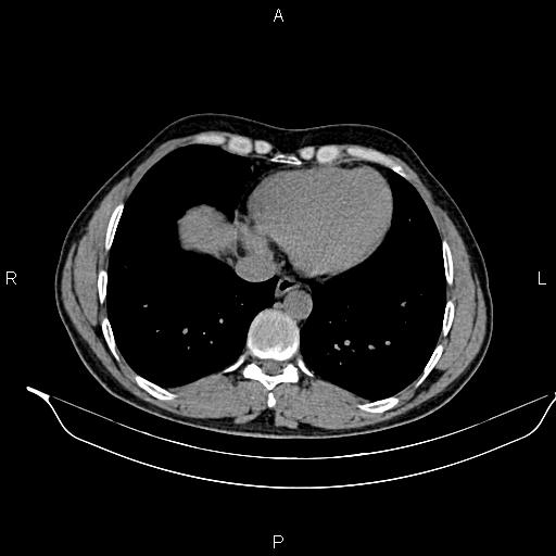 Adrenal myelolipoma (Radiopaedia 87794-104246 Axial non-contrast 10).jpg