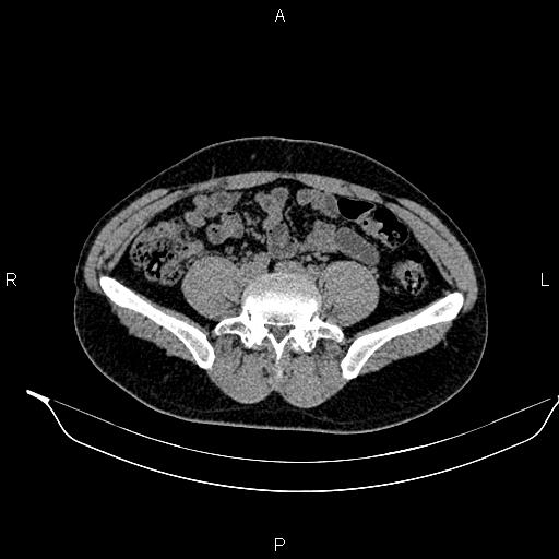 Adrenal myelolipoma (Radiopaedia 87794-104246 Axial non-contrast 71).jpg