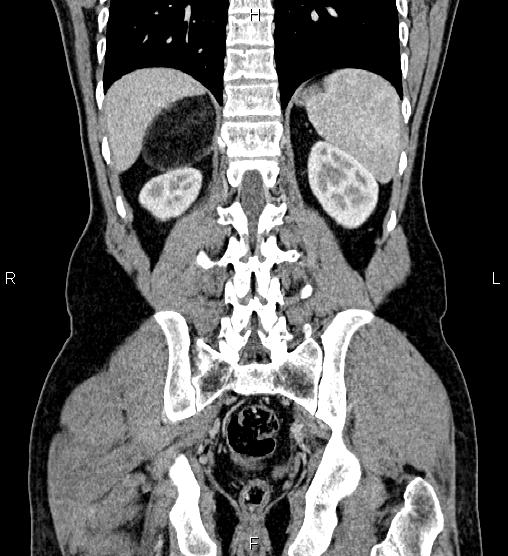 Adrenal myelolipoma (Radiopaedia 87794-104246 Coronal renal cortical phase 49).jpg