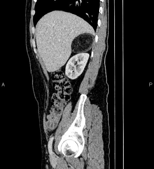 Adrenal myelolipoma (Radiopaedia 87794-104246 Sagittal renal cortical phase 22).jpg