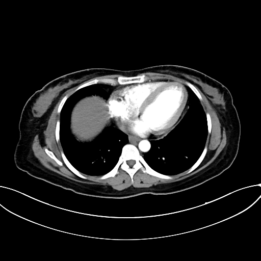 Adrenocortical carcinoma (Radiopaedia 87281-103569 Axial C+ arterial phase 8).jpg