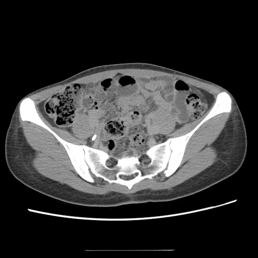 Adult polycystic kidney disease (Radiopaedia 48845-53876 Axial renal excretory phase 71).jpg