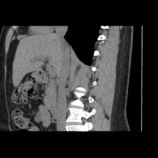 Adult polycystic kidney disease (Radiopaedia 59075-66368 Sagittal non-contrast 34).jpg