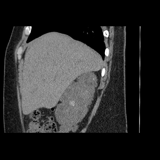 Adult polycystic kidney disease (Radiopaedia 59075-66368 Sagittal non-contrast 6).jpg