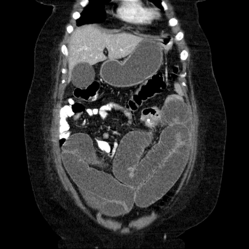 File:Afferent loop syndrome - secondary to incarcerated trocar site hernia (Radiopaedia 82959-97305 Coronal C+ portal venous phase 49).jpg