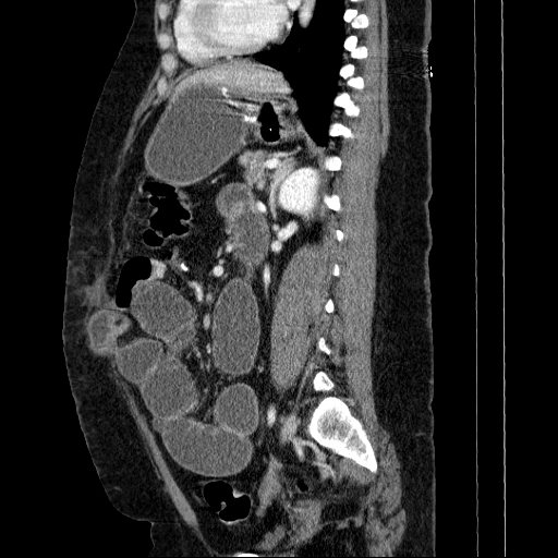Afferent loop syndrome - secondary to incarcerated trocar site hernia (Radiopaedia 82959-97305 Sagittal C+ portal venous phase 62).jpg