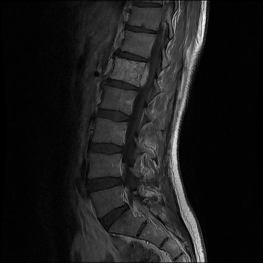 File:Aggressive vertebral hemangioma with pathological fracture (Radiopaedia 69528-79411 Sagittal T1 C+ 4).jpg