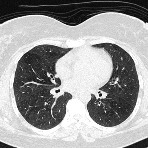 Air trapping in small airway disease (Radiopaedia 61685-69694 Axial lung window 85).jpg